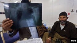 د پېښور په روغتون کې یو ډاکتر په نري رنځ د اخته کس اېکسرې ګوري - پخوانی انځور.